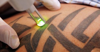 É possível remover a tatuagem?