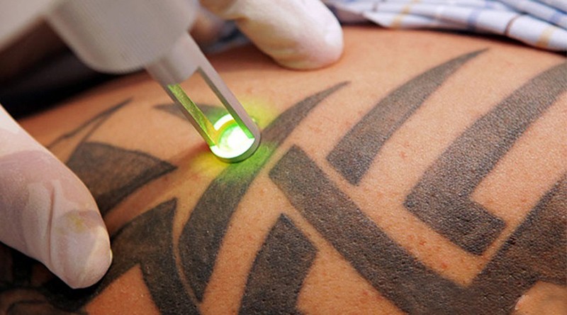 É possível remover a tatuagem?