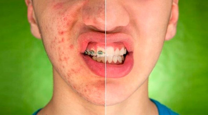 Tratamentos para cicatrizes de acne no rosto do homem